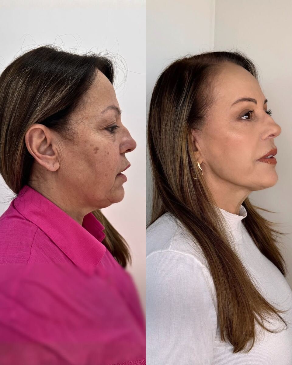 Antes e depois - transformação facial