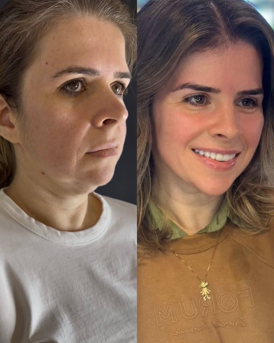 Antes e depois - transformação facial