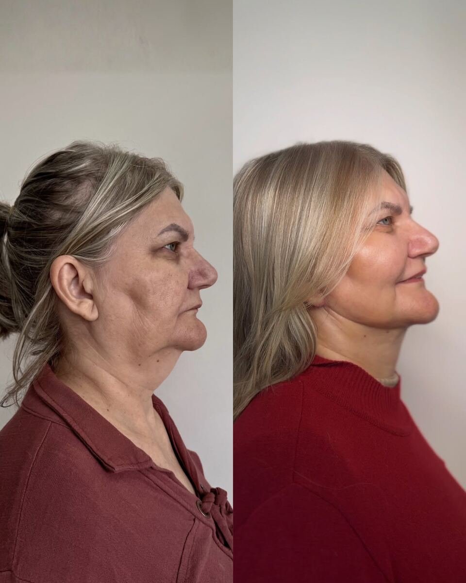 Antes e depois - transformação facial