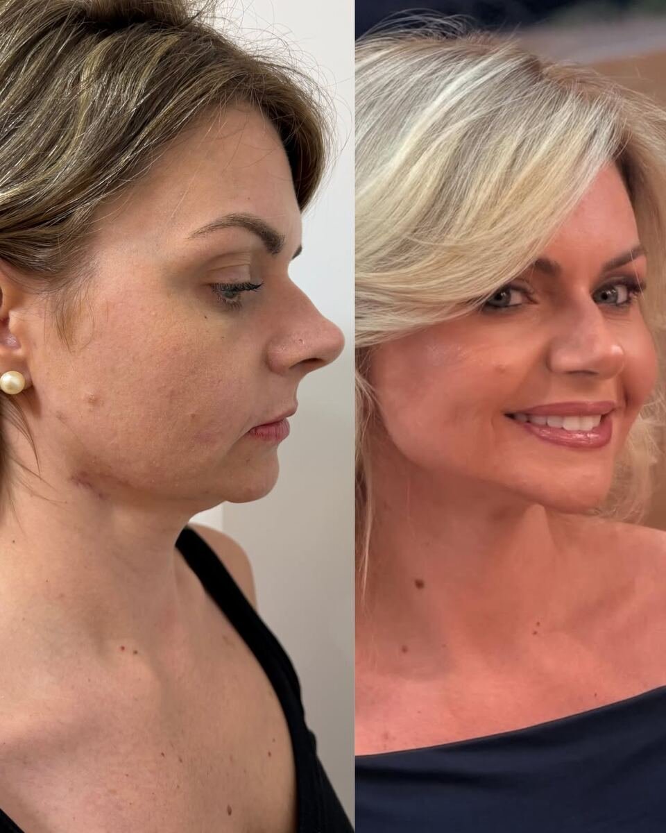 Antes e depois - transformação facial